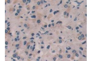 Detection of IL35 in Human Prostate cancer Tissue using Polyclonal Antibody to Interleukin 35 (IL35)