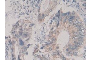 Detection of KIF18A in Human Colorectal cancer Tissue using Polyclonal Antibody to Kinesin Family, Member 18A (KIF18A)