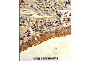Formalin-fixed and paraffin-embedded human lung carcinoma with S Antibody (C-term), which was peroxidase-conjugated to the secondary antibody, followed by DAB staining. (Osteopontin anticorps  (C-Term))