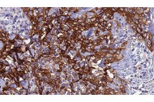ABIN6279138 at 1/100 staining Human Head and neck cancer tissue by IHC-P. (Aquaporin 8 anticorps  (N-Term))