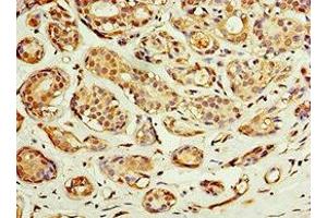 Immunohistochemistry of paraffin-embedded human breast cancer using ABIN7143229 at dilution of 1:100