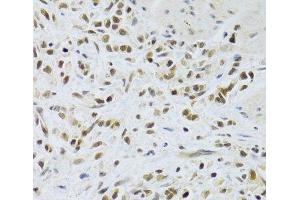 Immunohistochemistry of paraffin-embedded Human gastric cancer using RAD50 Polyclonal Antibody at dilution of 1:100 (40x lens). (RAD50 anticorps)