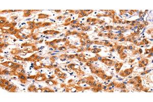 Immunohistochemistry of paraffin-embedded Human liver cancer tissue using FBLN1 Polyclonal Antibody at dilution 1:47 (Fibulin 1 anticorps)