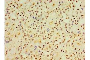 Immunohistochemistry of paraffin-embedded human breast cancer using ABIN7149845 at dilution of 1:100