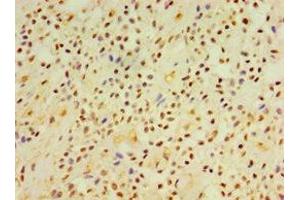 Immunohistochemistry of paraffin-embedded human breast cancer using ABIN7149845 at dilution of 1:100 (DGKE anticorps  (AA 40-260))