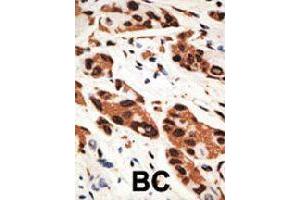 Formalin-fixed and paraffin-embedded human cancer tissue reacted with GJB5 polyclonal antibody  , which was peroxidase-conjugated to the secondary antibody, followed by AEC staining. (GJB5 anticorps  (Internal Region))