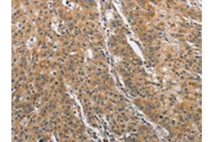 The image on the left is immunohistochemistry of paraffin-embedded Human gastric cancer tissue using ABIN7129185(DDX53 Antibody) at dilution 1/75, on the right is treated with fusion protein. (DDX53 anticorps)