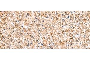 Immunohistochemistry of paraffin-embedded Human liver cancer tissue using HCCS Polyclonal Antibody at dilution of 1:110(x200)