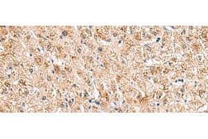 Immunohistochemistry of paraffin-embedded Human liver cancer tissue using HCCS Polyclonal Antibody at dilution of 1:110(x200) (HCCS anticorps)