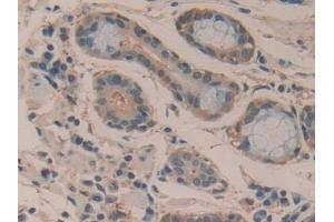 Detection of mTOR in Human Stomach cancer Tissue using Polyclonal Antibody to Serine/threonine-protein kinase mTOR (mTOR)