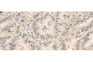 Immunohistochemistry of paraffin-embedded Human lung cancer tissue using HHIPL2 Polyclonal Antibody at dilution of 1:55(x200) (HHIPL2 anticorps)