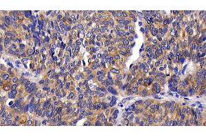 Detection of PKBa in Human Ovarian cancer Tissue using Polyclonal Antibody to Protein Kinase B Alpha (PKBa)