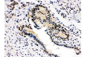 Anti-SMN1/2 Picoband antibody, (ABIN3043933),IHC(P)IHC(P): Human Mammary Cancer Tissue