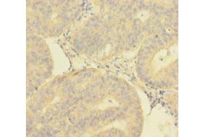 Immunohistochemistry of paraffin-embedded human endometrial cancer using ABIN7149718 at dilution of 1:100 (DNTTIP1 anticorps  (AA 1-329))