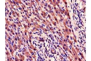 Immunohistochemistry of paraffin-embedded human liver cancer using ABIN7165238 at dilution of 1:100 (CYR61 anticorps  (AA 25-381))