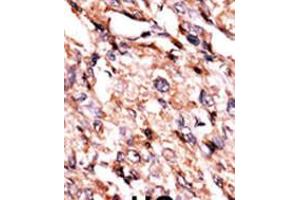 Formalin-fixed and paraffin-embedded human cancer tissue reacted with the primary antibody, which was peroxidase-conjugated to the secondary antibody, followed by AEC staining. (BCKDK anticorps  (AA 120-151))