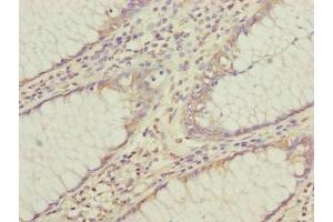 Immunohistochemistry of paraffin-embedded human colon cancer using ABIN7147439 at dilution of 1:100 (CEP95 anticorps  (AA 582-821))