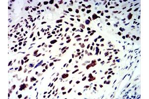 Immunohistochemical analysis of paraffin-embedded esophageal cancer tissues using SMARCA1 mouse mAb with DAB staining.