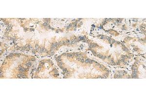 Immunohistochemistry of paraffin-embedded Human lung cancer tissue using RAB13 Polyclonal Antibody at dilution of 1:50(x200) (RAB13 anticorps)