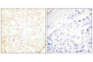 Immunohistochemistry analysis of paraffin-embedded human breast carcinoma tissue using XRCC5 antibody.