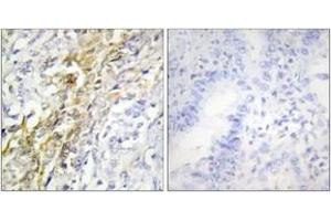 Immunohistochemistry analysis of paraffin-embedded human lung carcinoma tissue, using CKI-alpha Antibody. (CSNK1A1 anticorps  (AA 126-175))