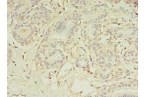 Immunohistochemistry of paraffin-embedded human breast cancer using ABIN7159399 at dilution of 1:100 (MS4A7 anticorps  (AA 1-47))