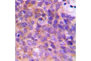 Immunohistochemical analysis of KCNAB3 staining in human breast cancer formalin fixed paraffin embedded tissue section.
