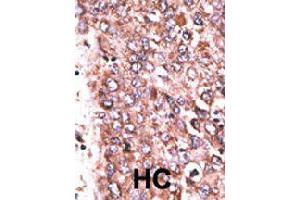 Formalin-fixed and paraffin-embedded human hepatocellular carcinoma tissue reacted with WISP3 polyclonal antibody  , which was peroxidase-conjugated to the secondary antibody, followed by DAB staining. (WISP3 anticorps  (Internal Region))