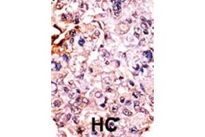 Formalin-fixed and paraffin-embedded human cancer tissue reacted with the primary antibody, which was peroxidase-conjugated to the secondary antibody, followed by AEC staining.