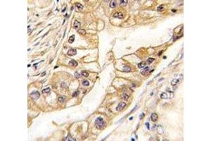 IHC analysis of FFPE human lung carcinoma tissue stained with EPHB2 antibody