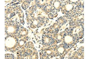 The image on the left is immunohistochemistry of paraffin-embedded Human thyroid cancer tissue using ABIN7193043(WDR91 Antibody) at dilution 1/20, on the right is treated with synthetic peptide. (WDR91 anticorps)