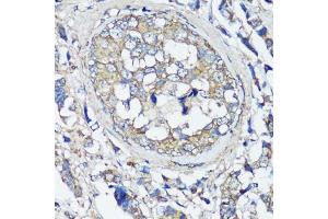 Immunohistochemistry of paraffin-embedded human breast cancer using V antibody (ABIN3021846, ABIN3021847, ABIN1513674 and ABIN6216136) at dilution of 1:100 (40x lens). (VAMP2 anticorps  (AA 1-100))