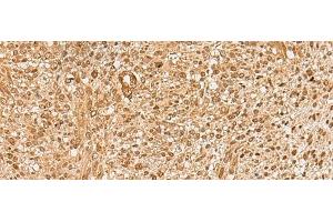Immunohistochemistry of paraffin-embedded Human liver cancer tissue using HIRIP3 Polyclonal Antibody at dilution of 1:60(x200) (HIRIP3 anticorps)
