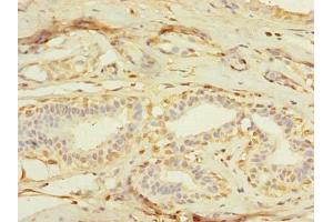 Immunohistochemistry of paraffin-embedded human breast cancer using ABIN7159074 at dilution of 1:100 (MXD3 anticorps  (AA 1-206))