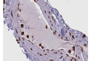 ABIN6267660 at 1/100 staining human lung carcinoma tissue sections by IHC-P. (SMAD1 anticorps  (pSer465))