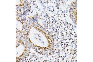 Immunohistochemistry of paraffin-embedded human colon carcinoma using RHOG antibody (ABIN7269864) at dilution of 1:100 (40x lens). (RHOG anticorps)
