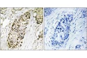 Immunohistochemistry analysis of paraffin-embedded human lung carcinoma tissue, using GA45G Antibody. (GADD45G anticorps  (AA 101-150))