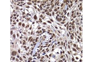 Immunohistochemistry of paraffin-embedded Human well-differentiated squamous skin carcinoma using DNAJB6 Polyclonal Antibody at dilution of 1:100 (40x lens). (DNAJB6 anticorps)