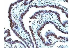 Formalin-fixed, paraffin-embedded human ovarian carcinoma stained with Histone H1 antibody (AE-4)