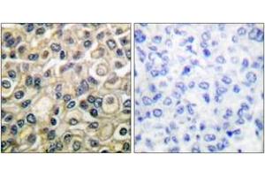 Immunohistochemistry analysis of paraffin-embedded human breast carcinoma tissue, using Claudin 1 Antibody.