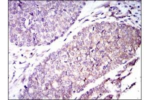 Immunohistochemical analysis of paraffin-embedded esophageal cancer tissues using GUCY1A3 mouse mAb with DAB staining. (GUCY1A1 anticorps  (AA 22-214))