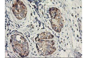 Immunohistochemical staining of paraffin-embedded Adenocarcinoma of Human breast tissue using anti-DAND5 mouse monoclonal antibody. (DAND5 anticorps  (AA 23-189))