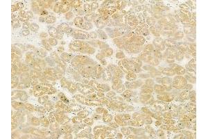 ABIN6261091 and ABIN6279109 at 1/100 staining human renal cell carcinoma by IHC-P. (CTNNAL1 anticorps  (Internal Region))