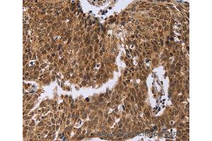 Immunohistochemistry of Human colon cancer using ERCC6L Polyclonal Antibody at dilution of 1:30 (ERCC6L anticorps)