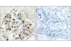 Immunohistochemistry analysis of paraffin-embedded human breast carcinoma tissue, using AF4 Antibody. (AF4 anticorps  (AA 1-50))