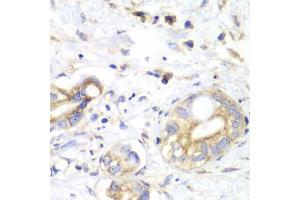 Immunohistochemistry of paraffin-embedded human liver cancer using TXN2 antibody (ABIN6291019) at dilution of 1:100 (40x lens). (TXN2 anticorps)
