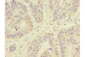Immunohistochemistry of paraffin-embedded human colon cancer using ABIN7167980 at dilution of 1:100 (ARHGEF3 anticorps  (AA 287-526))