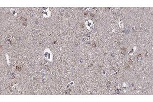 ABIN6276680 at 1/100 staining Human brain cancer tissue by IHC-P. (TLR3 anticorps  (C-Term))