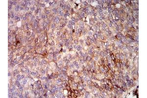 Immunohistochemical analysis of paraffin-embedded bladder cancer tissues using HLA-B mouse mAb with DAB staining.