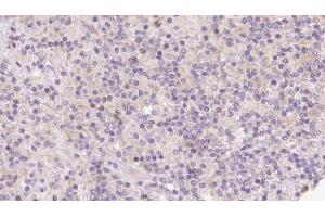 ABIN6273124 at 1/100 staining Human lymph cancer tissue by IHC-P. (HOMER1 anticorps  (Internal Region))